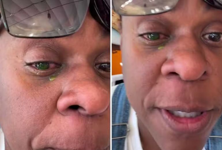 Cacau Protásio relata cegueira temporária e dor intensa após uso de pomada